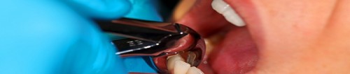 dentist performing dental extraction