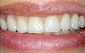 Phoenix-dentist-after