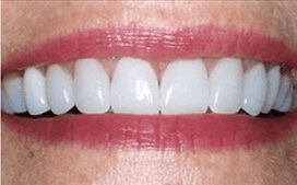 Phoenix-dentist-cosmetic-reconstruction-after