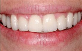 Vaneers-Phoenix-dentist-after