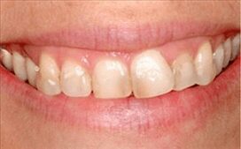 vaneers-phoenix-dentist-before