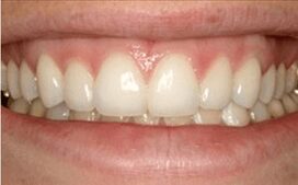 veneers-Phoenix-dentist-after