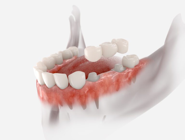 Dental Bridges in phoenix az 2