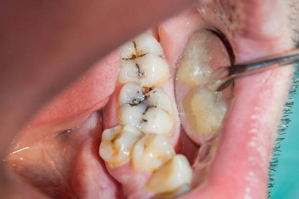 Root Canal Treatment in Phoenix