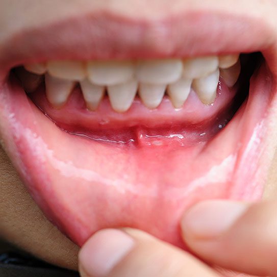 gum recession 2026 543
